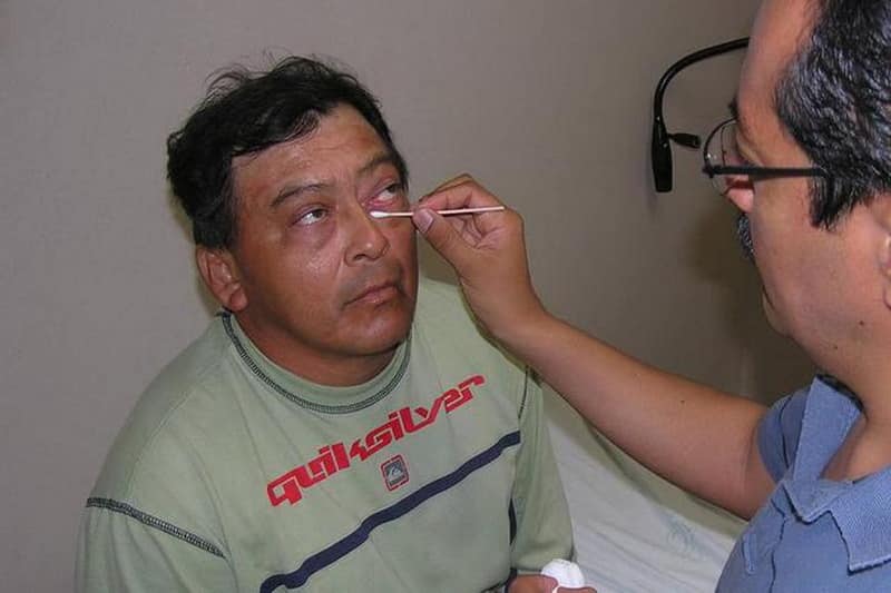 Conjuntivitis, tendrá descenso en el sur, pero se agudizará en el norte de Q. Roo