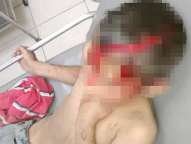 «Pitbull» ataca a menor de edad, le lesiona el rostro