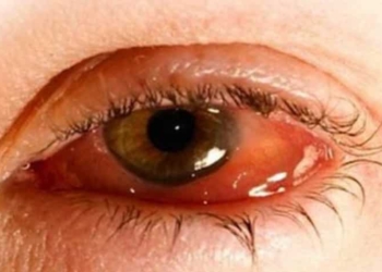 Quintana Roo, con más de 35 mil casos de Conjuntivitis