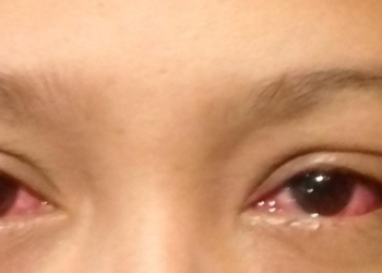 Sin llegar al estado crítico, conjuntivitis se prolifera en Q. Roo