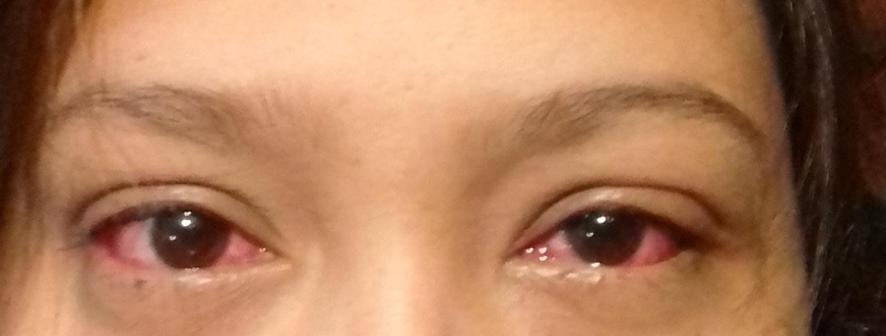 Sin llegar al estado crítico, conjuntivitis se prolifera en Q. Roo