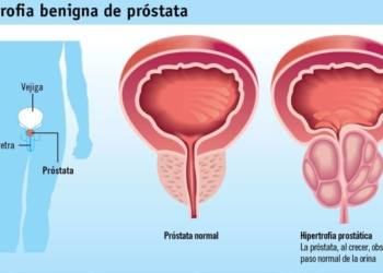 El cáncer de próstata es la segunda causa de muerte en hombres.