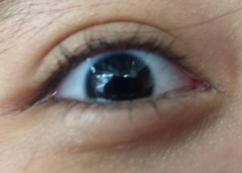 Vigilancia epidemiológica debido al brote de la conjuntivitis en el estado vecino de Yucatán