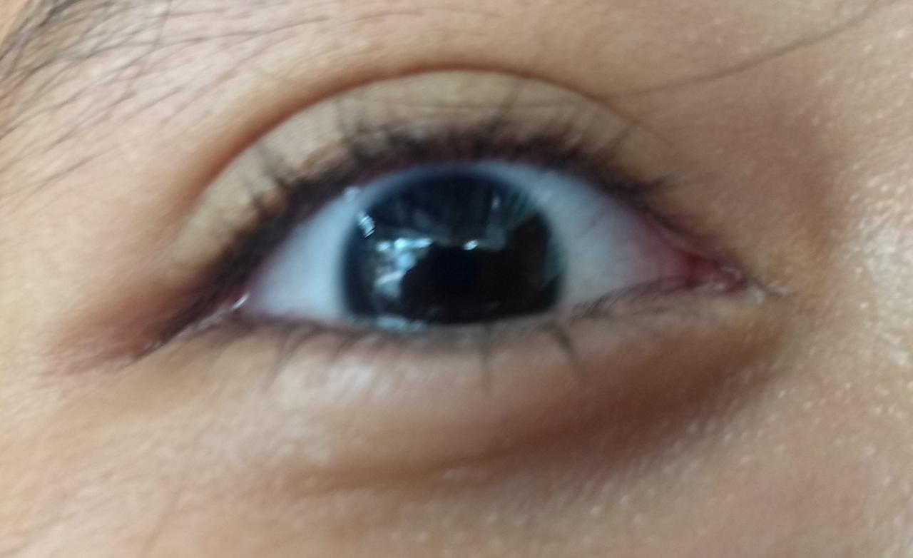 Vigilancia epidemiológica debido al brote de la conjuntivitis en el estado vecino de Yucatán