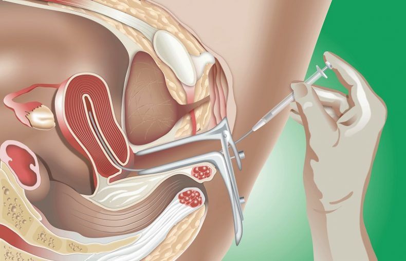 Inseminación artificial y Fertilización In vitro, los métodos de reproducción más utilizados por mujeres solteras