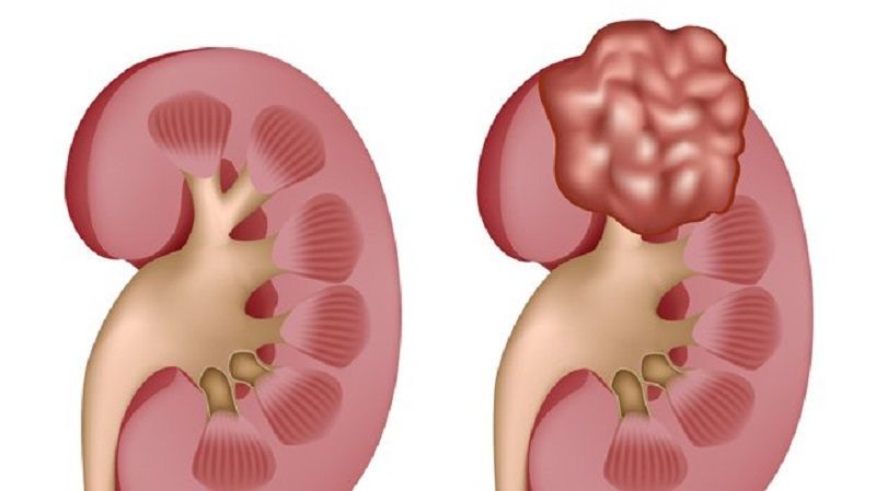 Nueva alternativa inmuno – oncológica para pacientes con cáncer renal y cáncer de vejiga