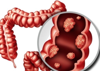 Desmitifican riesgos para desarrollar cáncer colorrectal y llaman a sumar más vida