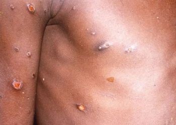 Ya son nueve casos de viruela símica en Quintana Roo, ocupa el cuarto lugar nacional
