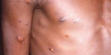 Ya son nueve casos de viruela símica en Quintana Roo, ocupa el cuarto lugar nacional