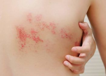 Farmacias Benavides proporciona vacunas contra el Herpes Zóster