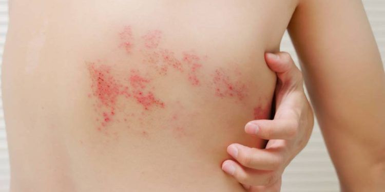 Farmacias Benavides proporciona vacunas contra el Herpes Zóster
