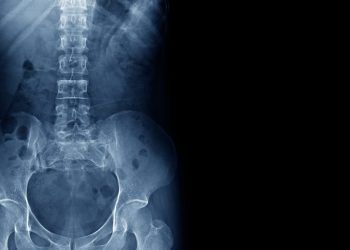 A través de la innovación científica, pacientes con Espondiloartritis pueden alcanzar el control de su enfermedad
