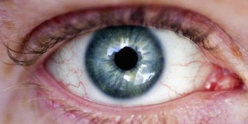 Enfermedades raras pueden comprometer la salud ocular