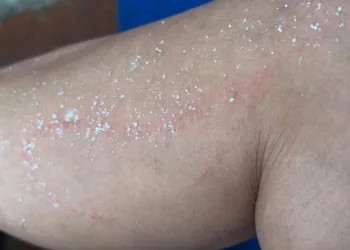 Vecina de Chemuyil denuncia infección en la piel por agua contaminada; acusan omisión de CAPA